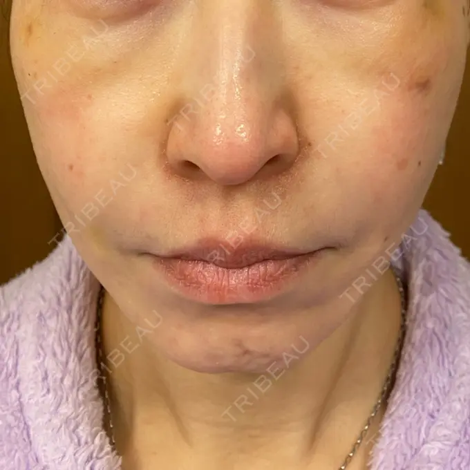 糸リフト / 肌ヒアルロン酸注入（たるみ・シワ改善） TCB東京中央美容外科 宇都宮院 DAY 8 メイン用