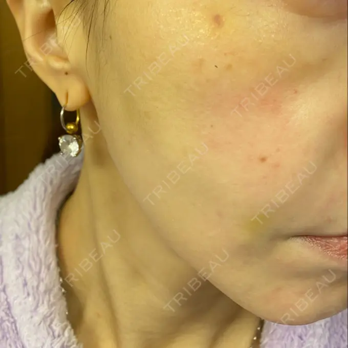 糸リフト / 肌ヒアルロン酸注入（たるみ・シワ改善） TCB東京中央美容外科 宇都宮院 DAY 8 メイン用