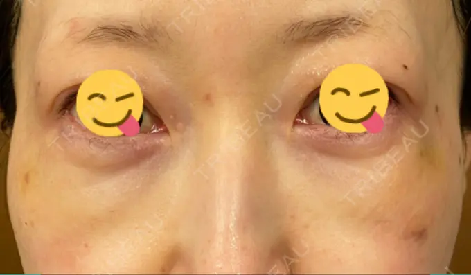 シワ取りボトックス / スネコス TCB東京中央美容外科 宇都宮院 DAY 8 メイン用