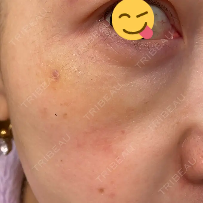 シワ取りボトックス / スネコス TCB東京中央美容外科 宇都宮院 DAY 8 メイン用