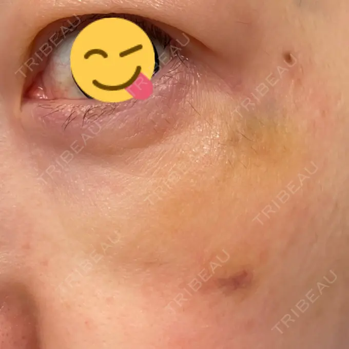 シワ取りボトックス / スネコス TCB東京中央美容外科 宇都宮院 DAY 8 メイン用