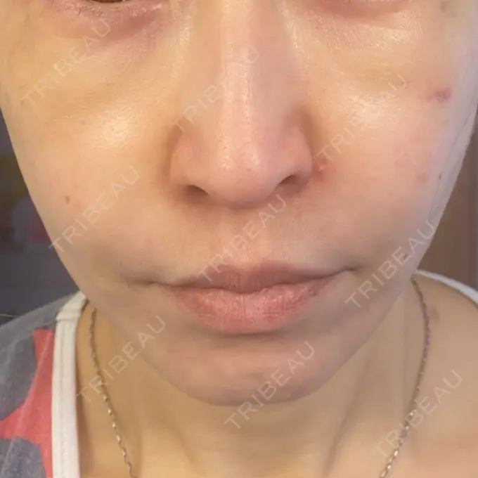 糸リフト / 肌ヒアルロン酸注入（たるみ・シワ改善） TCB東京中央美容外科 宇都宮院 DAY 12 メイン用