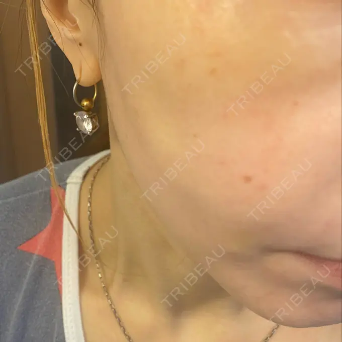 糸リフト / 肌ヒアルロン酸注入（たるみ・シワ改善） TCB東京中央美容外科 宇都宮院 DAY 12 メイン用