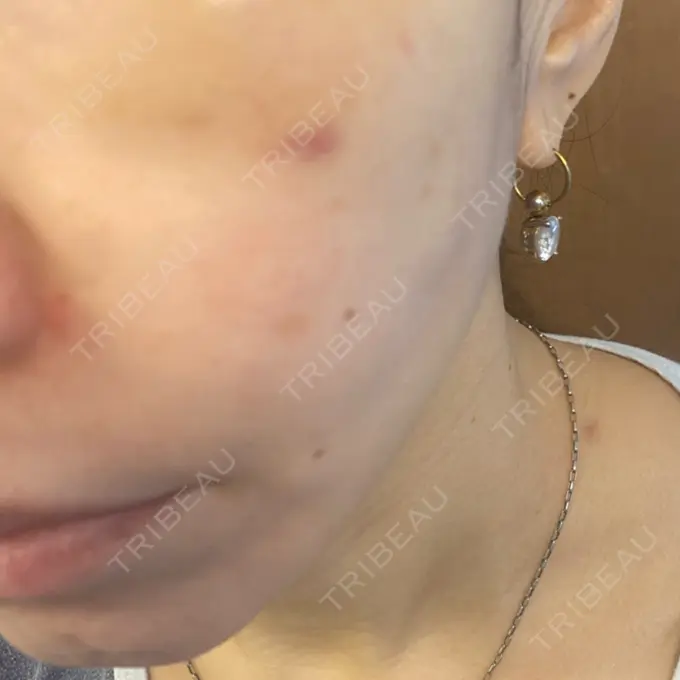 糸リフト / 肌ヒアルロン酸注入（たるみ・シワ改善） TCB東京中央美容外科 宇都宮院 DAY 12 メイン用