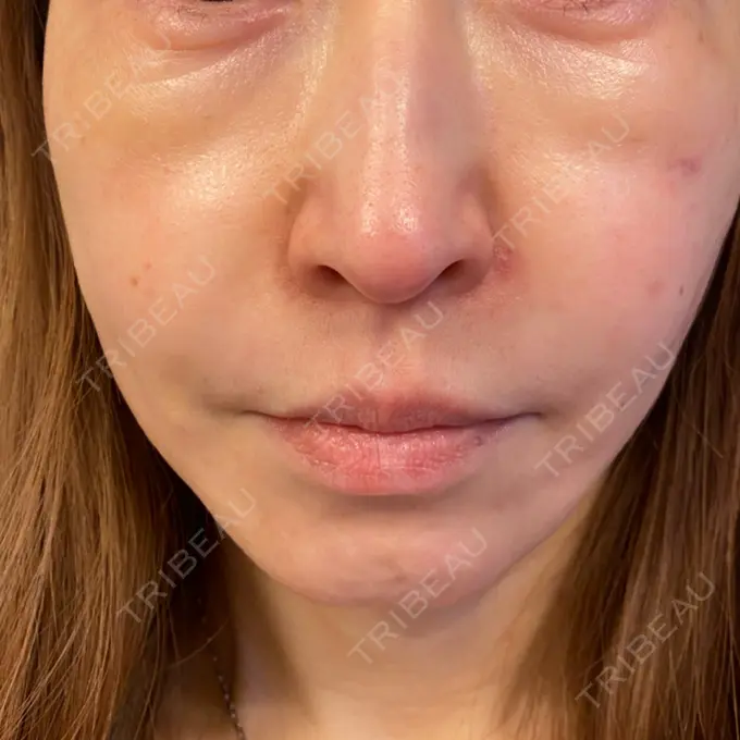 糸リフト / 肌ヒアルロン酸注入（たるみ・シワ改善） TCB東京中央美容外科 宇都宮院 DAY 15 メイン用