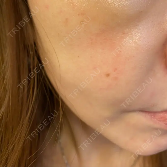 糸リフト / 肌ヒアルロン酸注入（たるみ・シワ改善） TCB東京中央美容外科 宇都宮院 DAY 15 メイン用