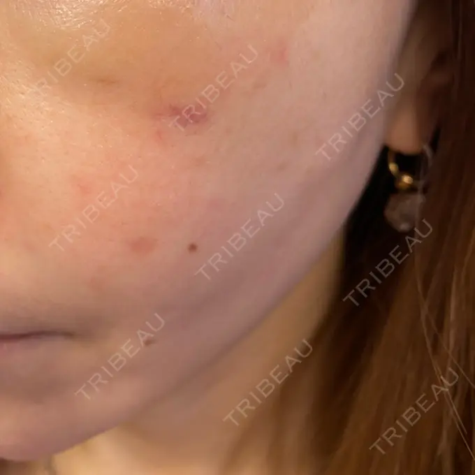 糸リフト / 肌ヒアルロン酸注入（たるみ・シワ改善） TCB東京中央美容外科 宇都宮院 DAY 15 メイン用