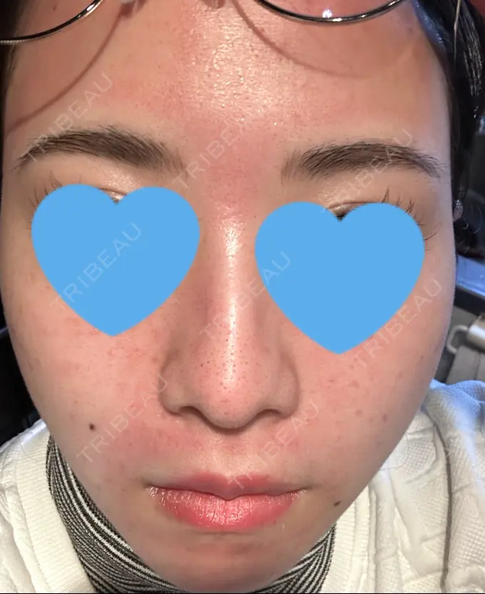 毛穴洗浄（ハイドラフェイシャルなど） / ヴェルヴェットスキン 日本美容・医療クリニック 六本木院 DAY 0 メイン用