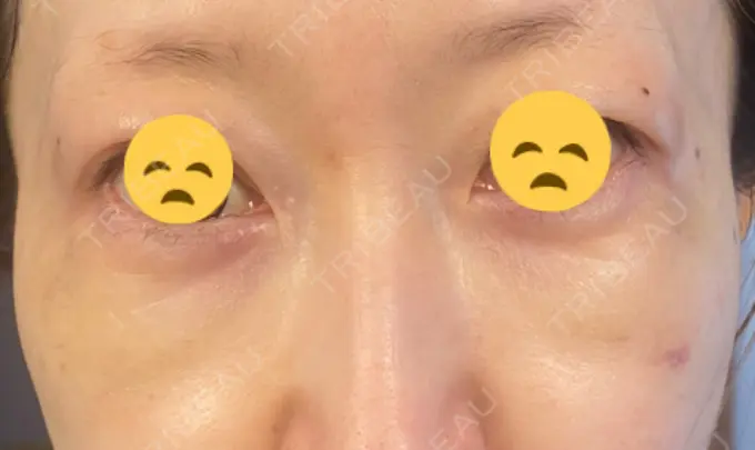 シワ取りボトックス / スネコス TCB東京中央美容外科 宇都宮院 DAY 12 メイン用