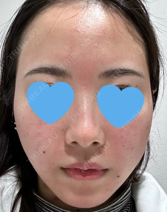 毛穴洗浄（ハイドラフェイシャルなど） / ヴェルヴェットスキン 日本美容・医療クリニック 六本木院 DAY 1 メイン用