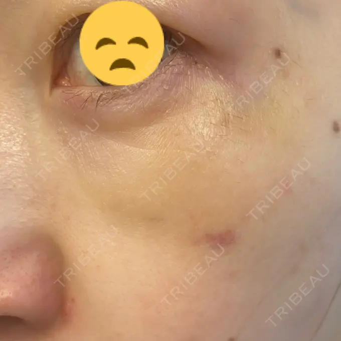 シワ取りボトックス / スネコス TCB東京中央美容外科 宇都宮院 DAY 12 メイン用