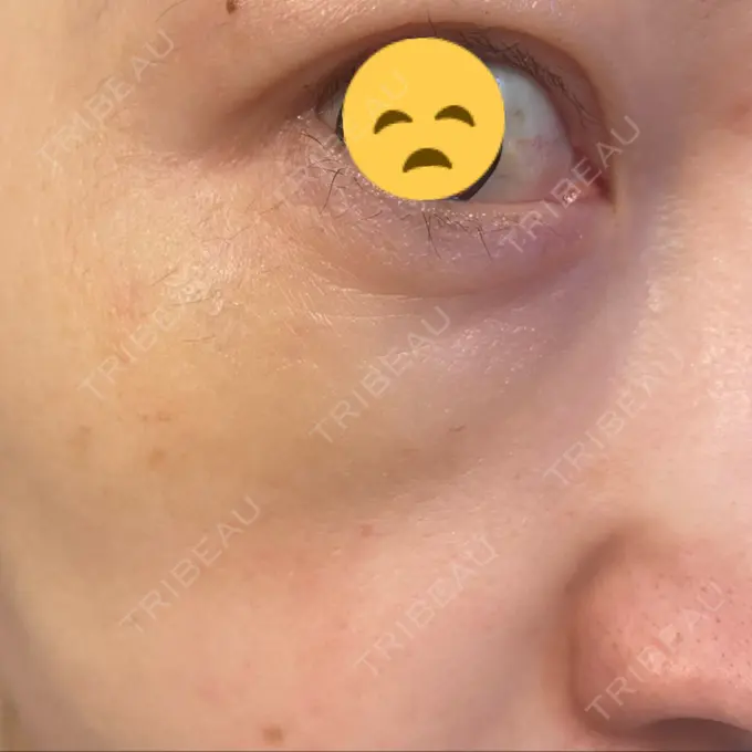 シワ取りボトックス / スネコス TCB東京中央美容外科 宇都宮院 DAY 12 メイン用