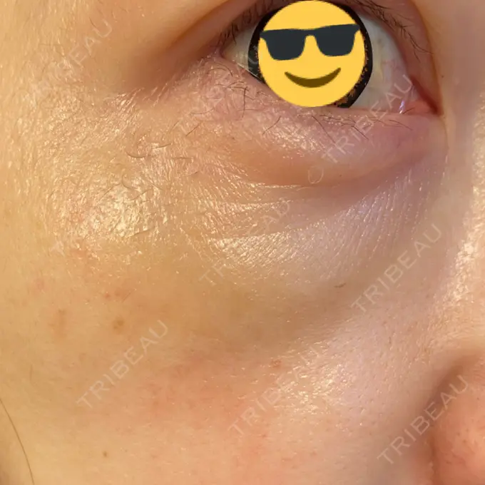 シワ取りボトックス / スネコス TCB東京中央美容外科 宇都宮院 AFTER メイン用