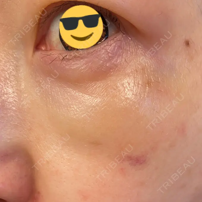 シワ取りボトックス / スネコス TCB東京中央美容外科 宇都宮院 DAY 15 メイン用