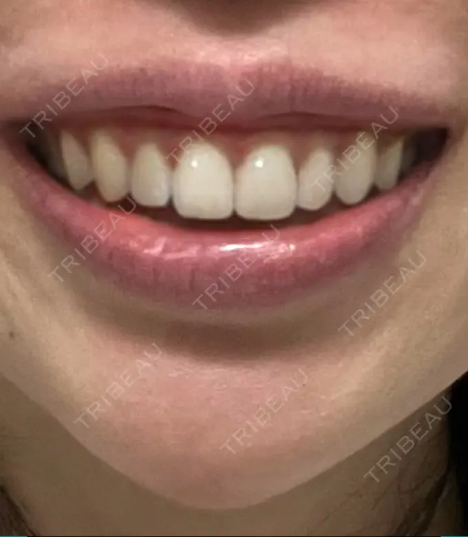 ボトックス（ガミースマイル） 椿クリニック 心斎橋院 DAY 5 メイン用