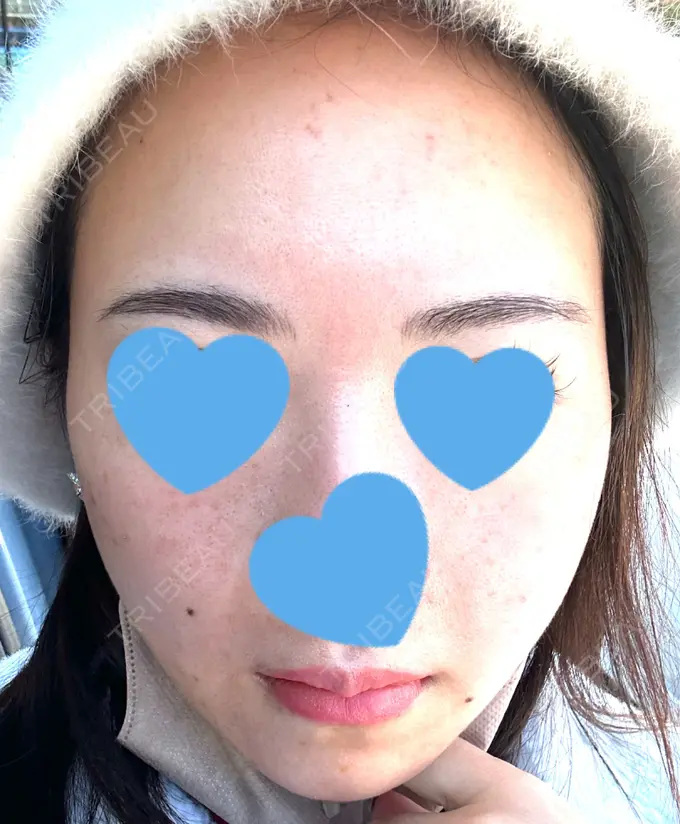 毛穴洗浄（ハイドラフェイシャルなど） / ヴェルヴェットスキン 日本美容・医療クリニック 六本木院 DAY 2 メイン用