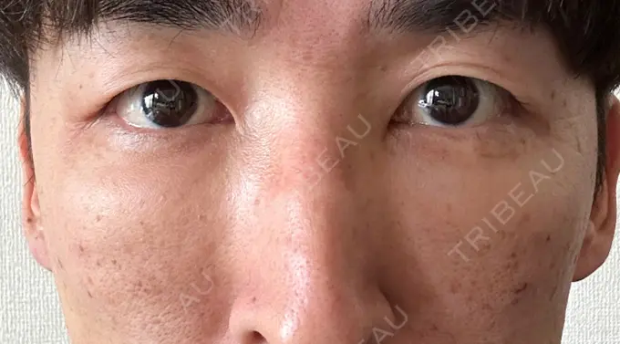 下まぶたたるみ取り / 脂肪注入（目の下） 湘南美容クリニック 池袋東口院 DAY 2 メイン用