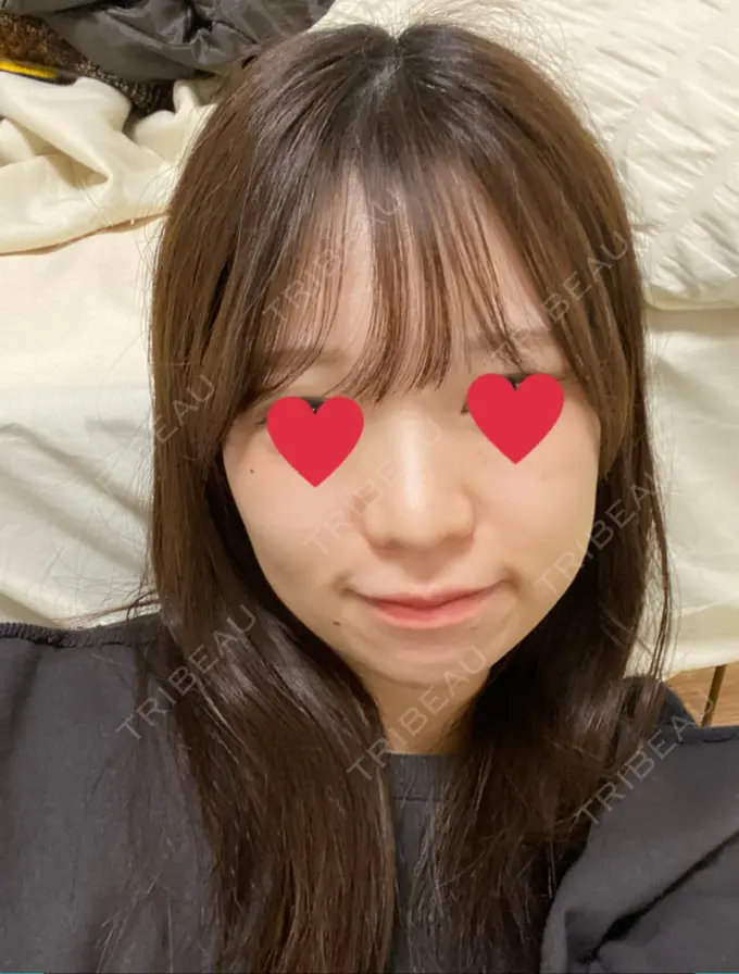 バッカルファット除去 / 脂肪吸引（顔） / ジョールファット除去 / ボトックス（エラ・小顔） 東京シンデレラ美容外科 池袋院 DAY 37 メイン用