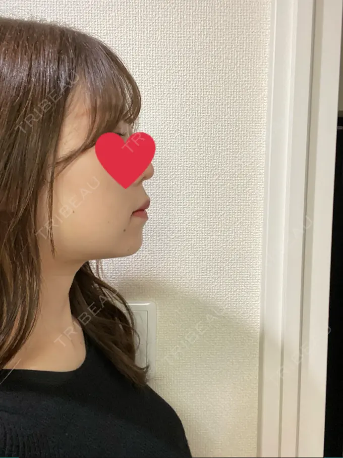 バッカルファット除去 / 脂肪吸引（顔） / ジョールファット除去 / ボトックス（エラ・小顔） 東京シンデレラ美容外科 池袋院 DAY 37 メイン用