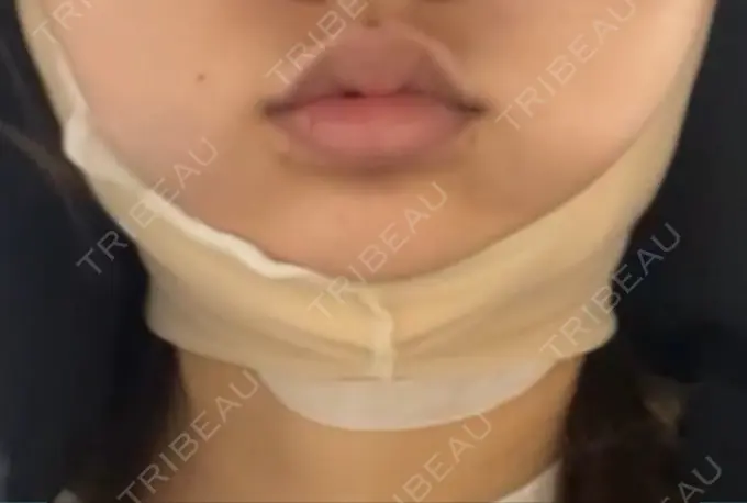 脂肪吸引（顔） 大塚美容形成外科 金沢院 DAY 0 メイン用