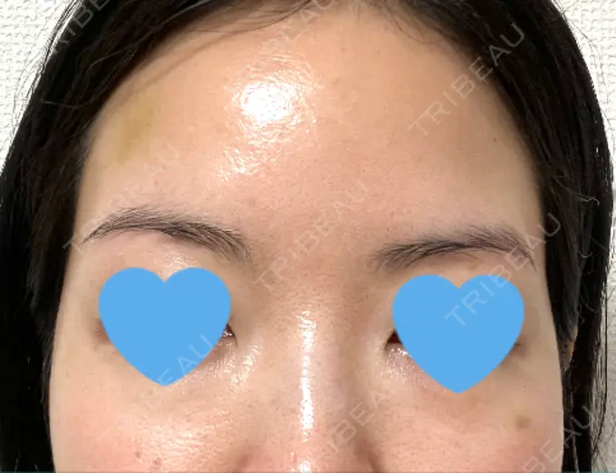 ボトックス（眉間） / ボトックス（額） TCB東京中央美容外科 自由が丘院 DAY 7 メイン用