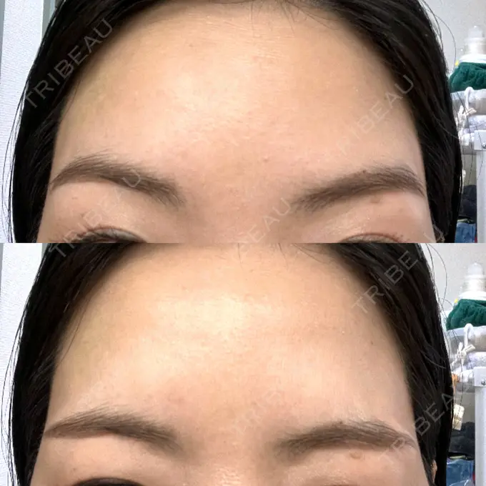 ボトックス（眉間） / ボトックス（額） TCB東京中央美容外科 自由が丘院 DAY 8 メイン用