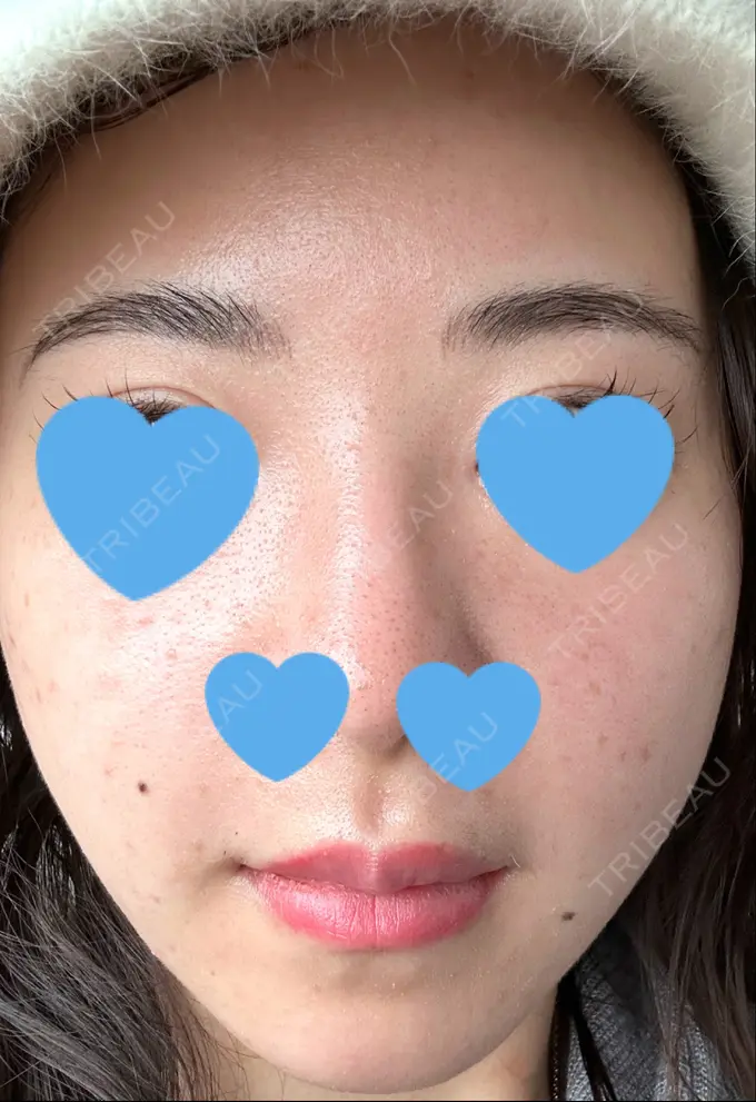 毛穴洗浄（ハイドラフェイシャルなど） / ヴェルヴェットスキン 日本美容・医療クリニック 六本木院 AFTER メイン用