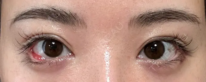 目尻切開 / タレ目形成・グラマラスライン（埋没） LOUIS CLINIC 二子玉川院【ルイクリニック】 DAY 4 メイン用