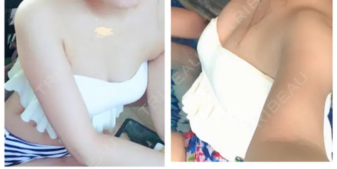 脂肪吸引（脚） / 豊胸（脂肪注入） 4ever(フォーエバー)美容外科・皮膚科 -江南店 AFTER メイン用