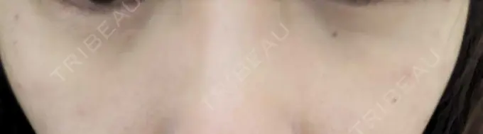 ヒアルロン酸注入（頬） / ヒアルロン酸注入（目の下） ルラ美容クリニック 神戸院 DAY 0 メイン用