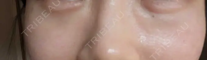 ヒアルロン酸注入（頬） / ヒアルロン酸注入（目の下） ルラ美容クリニック 神戸院 DAY 1 メイン用