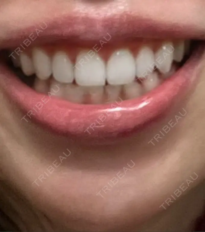 ボトックス（ガミースマイル） 椿クリニック 心斎橋院 DAY 7 メイン用