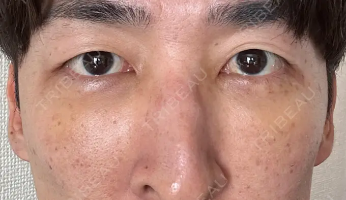 下まぶたたるみ取り / 脂肪注入（目の下） 湘南美容クリニック 池袋東口院 DAY 4 メイン用