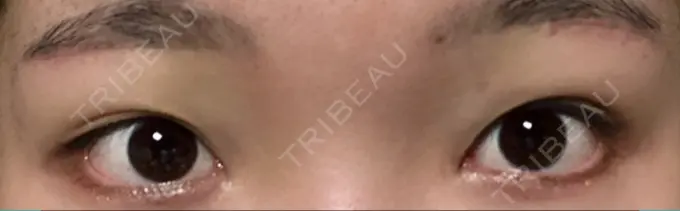 タレ目形成・グラマラスライン（切開） / 目尻靭帯移動 DIVINE（ディバイン）整形外科 DAY 25 メイン用