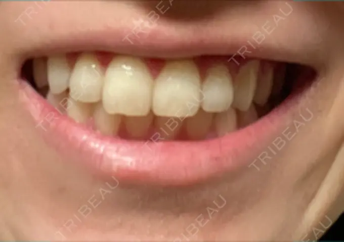 ホワイトニング オーラルビューティークリニック クラリス審美歯科・矯正歯科 DAY 25 メイン用