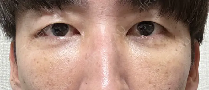 下まぶたたるみ取り / 脂肪注入（目の下） 湘南美容クリニック 池袋東口院 DAY 5 メイン用