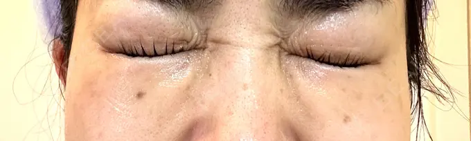 ボトックス（目尻） TCB東京中央美容外科 岡山院 DAY 8 メイン用