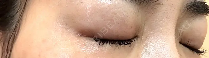 ボトックス（目尻） TCB東京中央美容外科 岡山院 DAY 8 メイン用