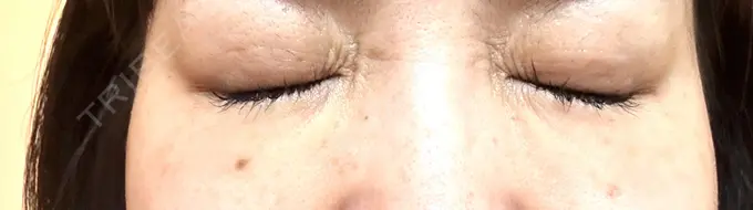 ボトックス（目尻） TCB東京中央美容外科 岡山院 DAY 9 メイン用