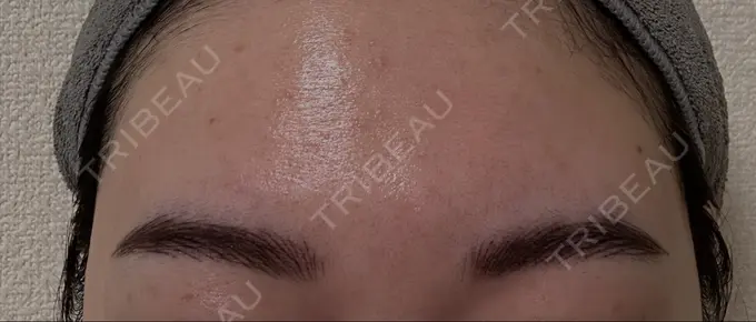 アートメイク（眉） MYCLINIC 西新宿 DAY 1 メイン用