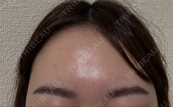 アートメイク（眉） MYCLINIC 西新宿 DAY 3 メイン用