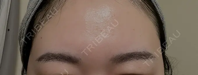 アートメイク（眉） MYCLINIC 西新宿 DAY 27 メイン用