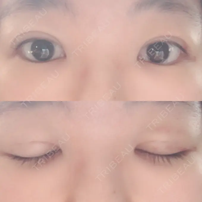 二重埋没 湘南美容クリニック 仙台院 DAY 12 メイン用