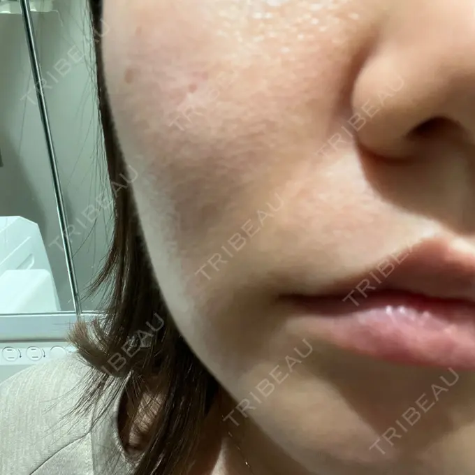 肌ヒアルロン酸注入（たるみ・シワ改善） 横浜TAクリニック AFTER メイン用