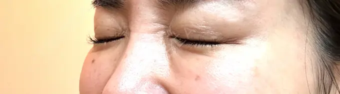 ボトックス（目尻） TCB東京中央美容外科 岡山院 DAY 14 メイン用