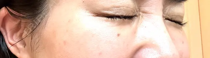 ボトックス（目尻） TCB東京中央美容外科 岡山院 DAY 14 メイン用