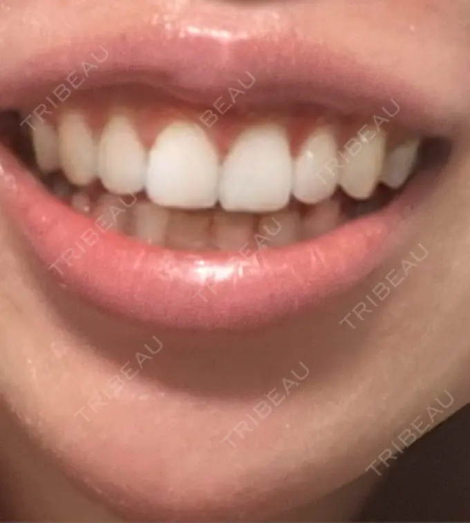 ボトックス（ガミースマイル） 椿クリニック 心斎橋院 DAY 10 メイン用