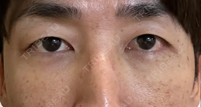 下まぶたたるみ取り / 脂肪注入（目の下） 湘南美容クリニック 池袋東口院 DAY 6 メイン用