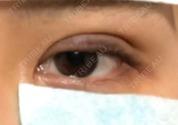 二重埋没 湘南美容クリニック 京都院 DAY 0 メイン用