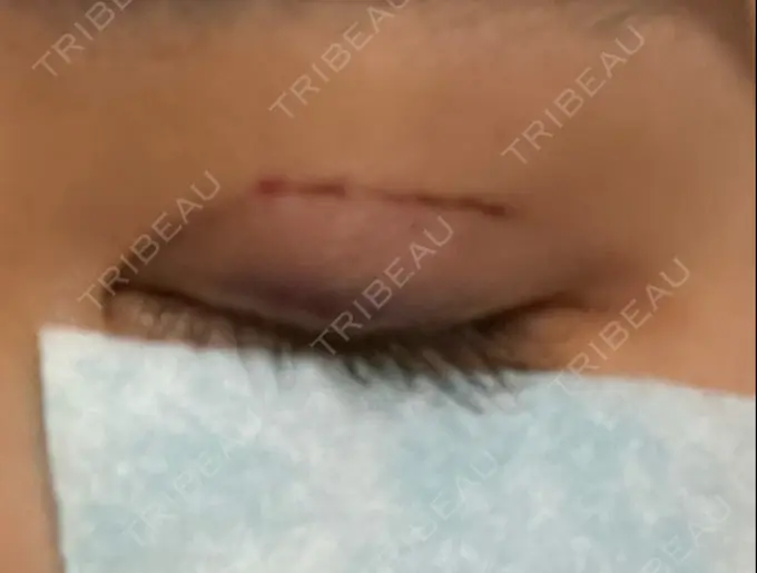 二重埋没 湘南美容クリニック 京都院 DAY 0 メイン用